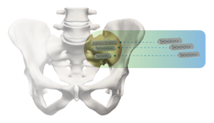 iFuse Implant can relieve SI Joint pain